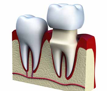 covington patients learn more about dental crowns 5f512b559b42f