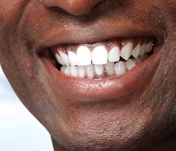 finding a dentist to provide mercury free fillings in covington 5f512b5dc726c