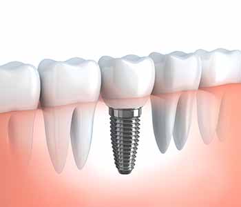 see what is possible with implant dentistry in covington 5f512b91b95d9